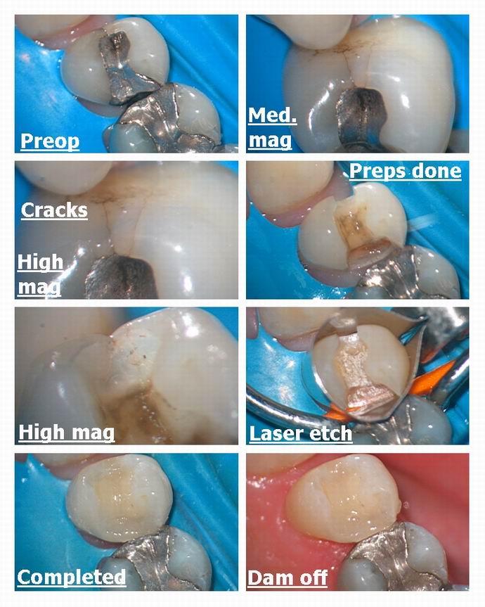 Resize of Cracked premolar filled with resin.jpg